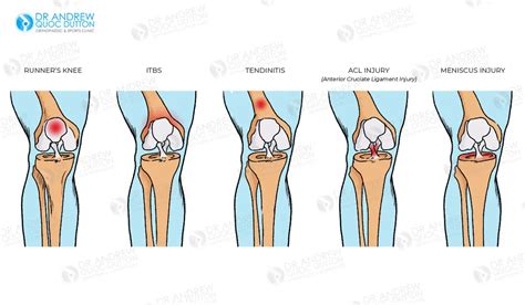 acl and meniscus surgery